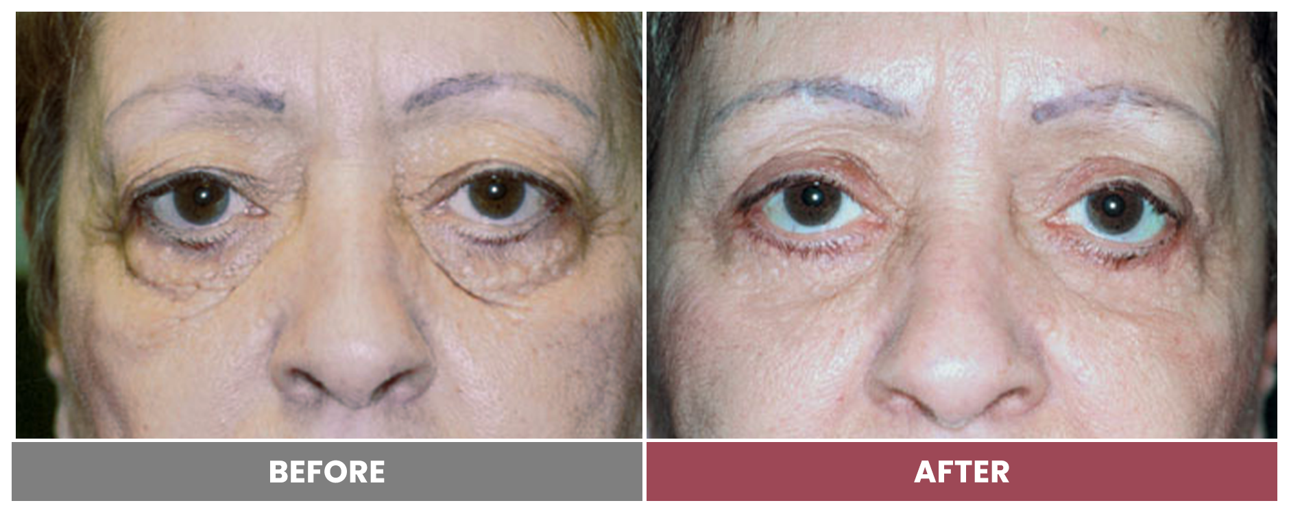 TUMOR REMOVAL AND RECONSTRUCTION - Case 6